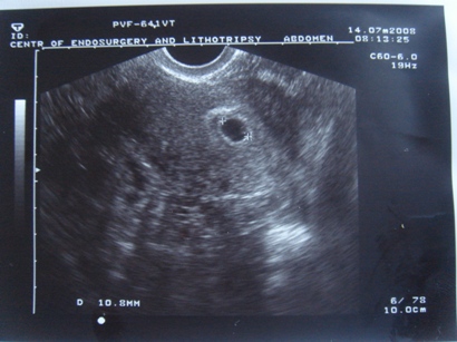 Анэмбриония или почему не видно эмбриона на УЗИ